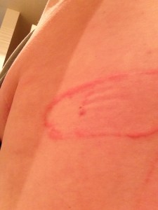 When physical therapy tape attacks. Houston, we have a problem!